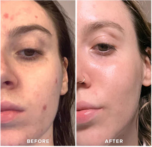Shenish™ Ice Roller for Face
