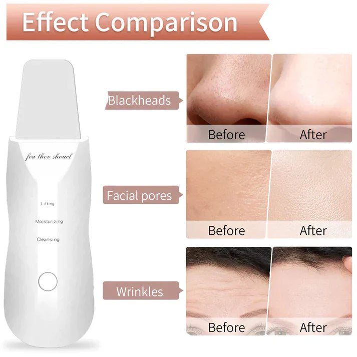 Shenish™ Ultrasonic 5-in-1 Facial Scrubber