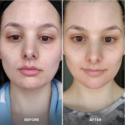 Shenish™ Ice Roller for Face